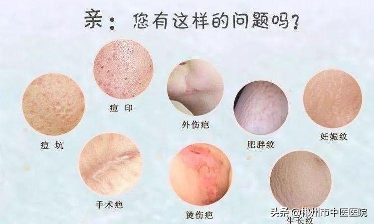 二氧化碳点阵激光被坑,二氧化碳点阵激光之后反黑怎么办