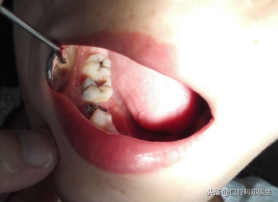 有蛀牙为什么医生建议不补牙齿,小孩子有蛀牙不疼怎么办