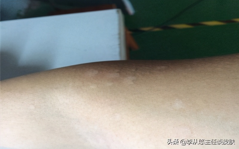 身上有几块白斑能被确诊白癜风,身上白色斑块怎么排除白癜风