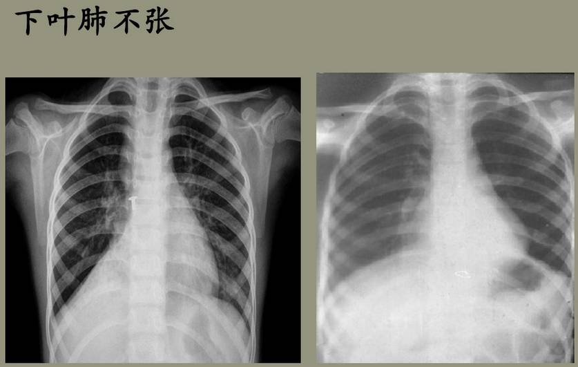 x线诊断边界模糊,x线诊断有误区吗