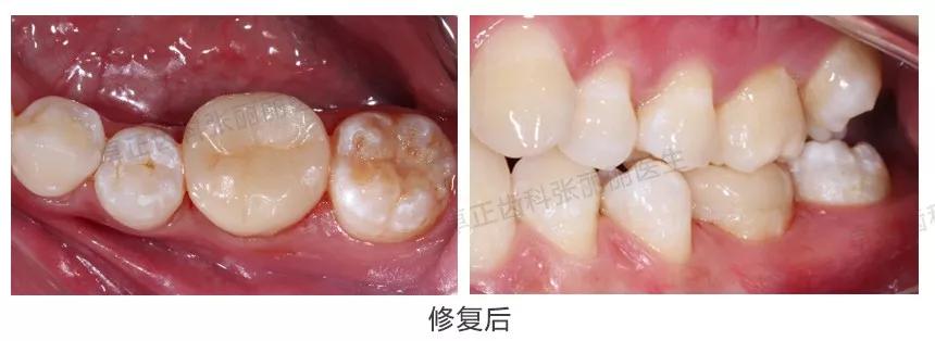 牙齿楔状缺损修复视频,牙齿缺损了可以选择哪些修复方式