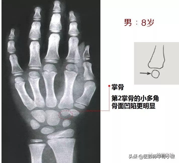 骨龄片对照图谱测骨龄准不,骨龄14岁男孩骨龄图谱