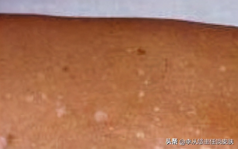 身上有几块白斑能被确诊白癜风,身上白色斑块怎么排除白癜风