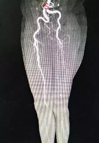 小腿血栓皮肤溃烂创面怎么处理,皮肤血管坏死怎么回事