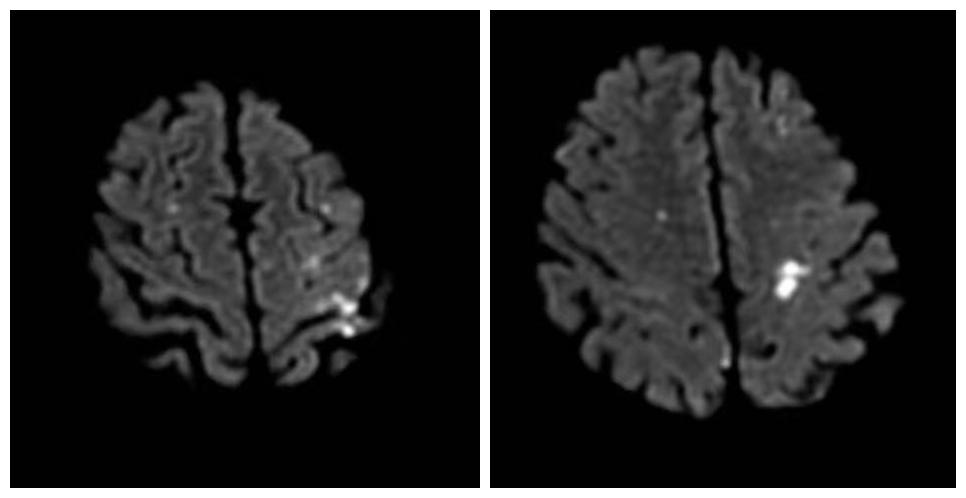 75岁老人多发性脑梗死,DSA介入治疗打通大脑“生命线”