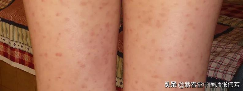 紫癜肾炎患者应该如何提高免疫力,小孩子过敏性紫癜肾炎好治吗