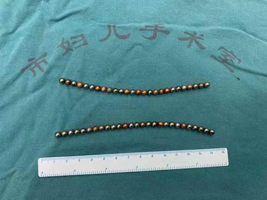 14岁男孩将53颗巴克球塞入尿道，次日中午发现自己上厕所时出血，引发失血性休克