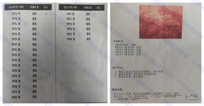 宫颈干扰素副作用及后遗症,宫颈炎干扰素要用药多久