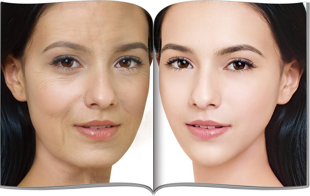 线雕提升如何通过特殊的布线思路将颧骨降低？