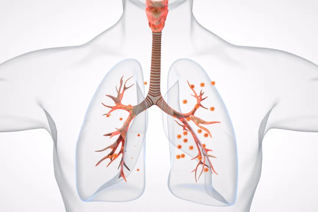 小儿慢性支气管炎如何调理,治疗小儿支气管炎最有效的药