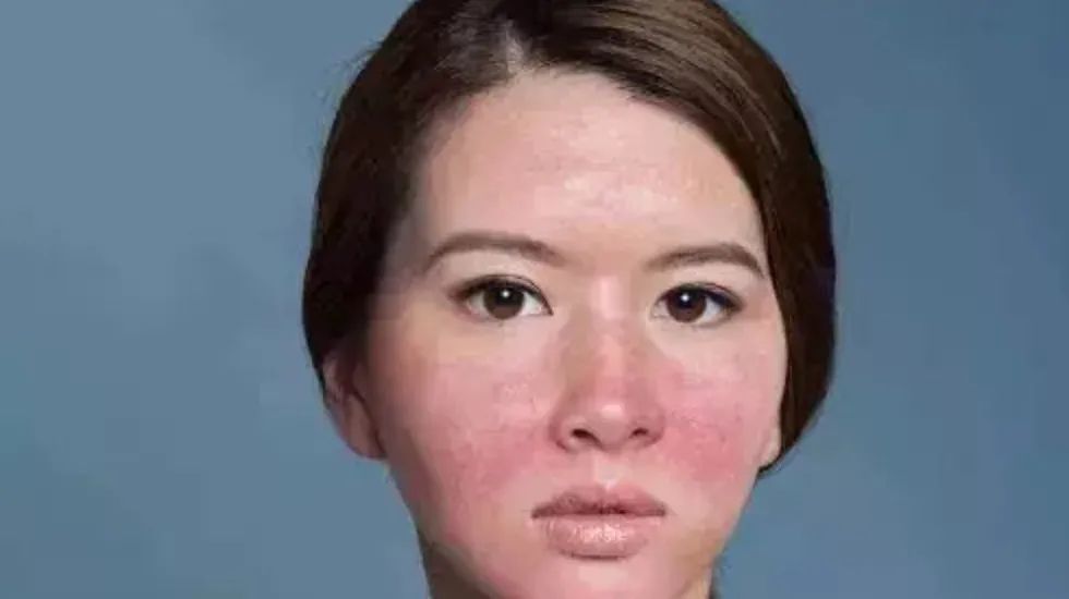 玫瑰*疮痤**不能游泳？也不能跑步健身？