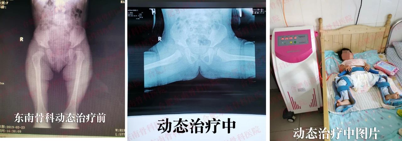 髋关节脱位宝宝保守治疗是怎样的,髋关节脱位宝宝护理