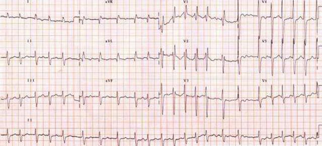 炙甘草汤治疗房颤组成及功效,炙甘草汤加减治房颤还需抗凝吗