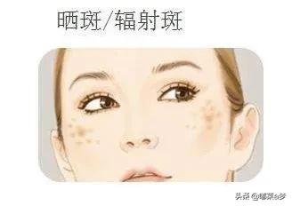 雀斑晒斑怎么去除中医,晒斑怎么祛斑最有效既省钱又简单