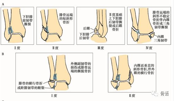 70岁老人骨质疏松性骨折怎么治疗,骨质疏松性骨折的治疗