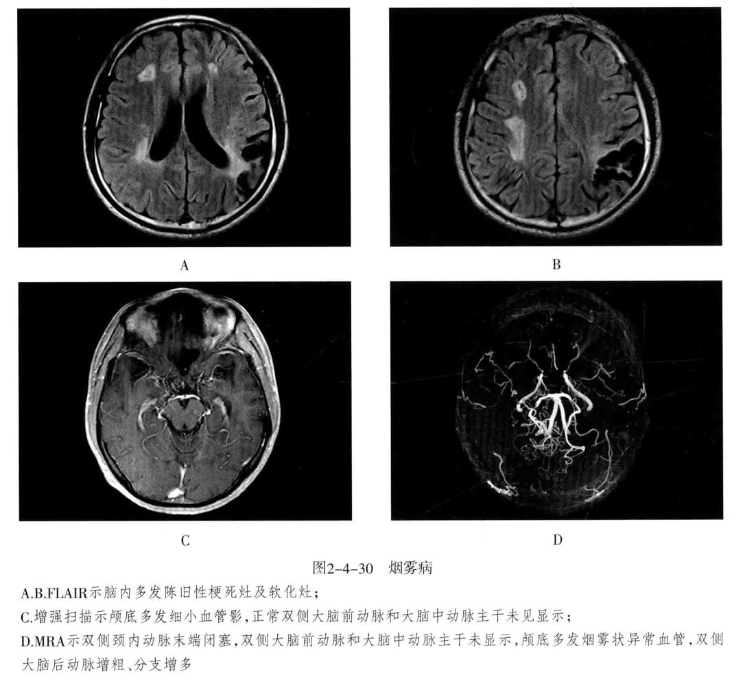 颅内血管周围间隙的影像鉴别,颅脑血管源性疾病影像诊断