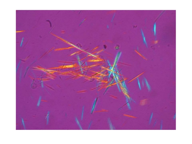 尿酸高调理肝有用吗,吃治疗尿酸高的药会导致肝损伤吗