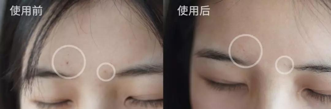 蜂胶消炎祛痘,蜂胶治疗皮癣吗