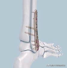 小孩胫骨和腓骨骨折未手术疼多久,14岁腓骨骨折保守治疗还是手术