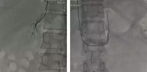 总医院高血压科,肾上腺静脉取血结果分析