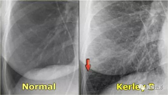 盘状肺不张多见于什么病,盘状肺不张解释