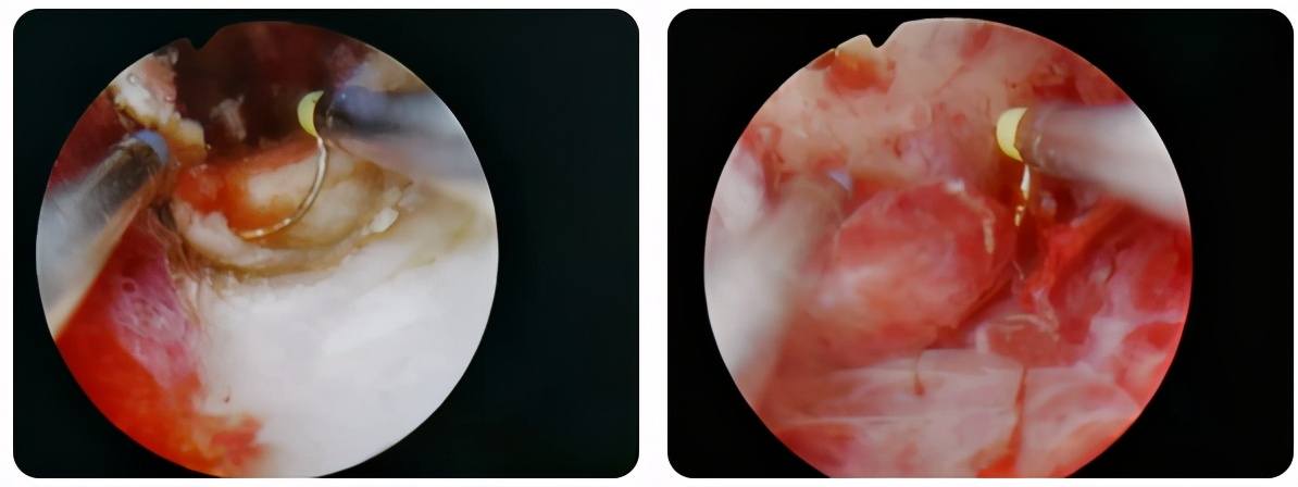 西青医院妇科顺利完成一例腔镜下子宫内膜癌一次全面分期手术