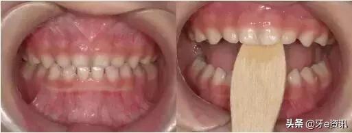 狗狗乳牙地包天怎么办,儿童乳牙地包天怎么办