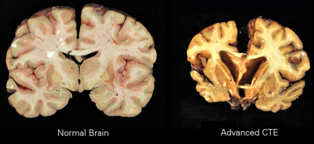 足球头球对智力影响,足球强身健体的作用有哪些