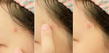 脸上老是长痘怎样内调,脸上老是长痘怎么办小妙招