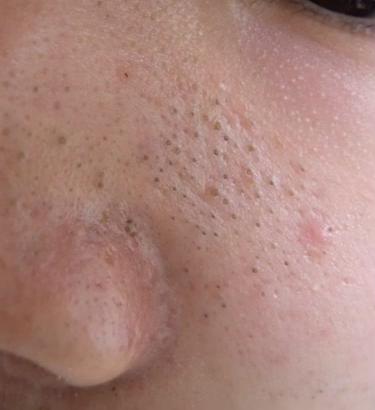 去除又黑又硬的黑头的方法,怎么祛除黑头的最有效方法