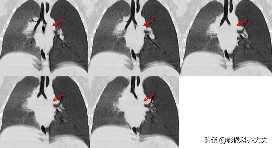 ct能查出气管微小异物嘛,气管异物ct怎么做