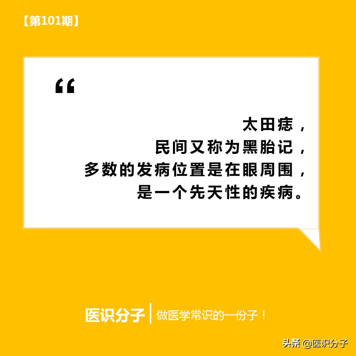 太田痣第二次激光效果,激光治疗颜色较深的太田痣