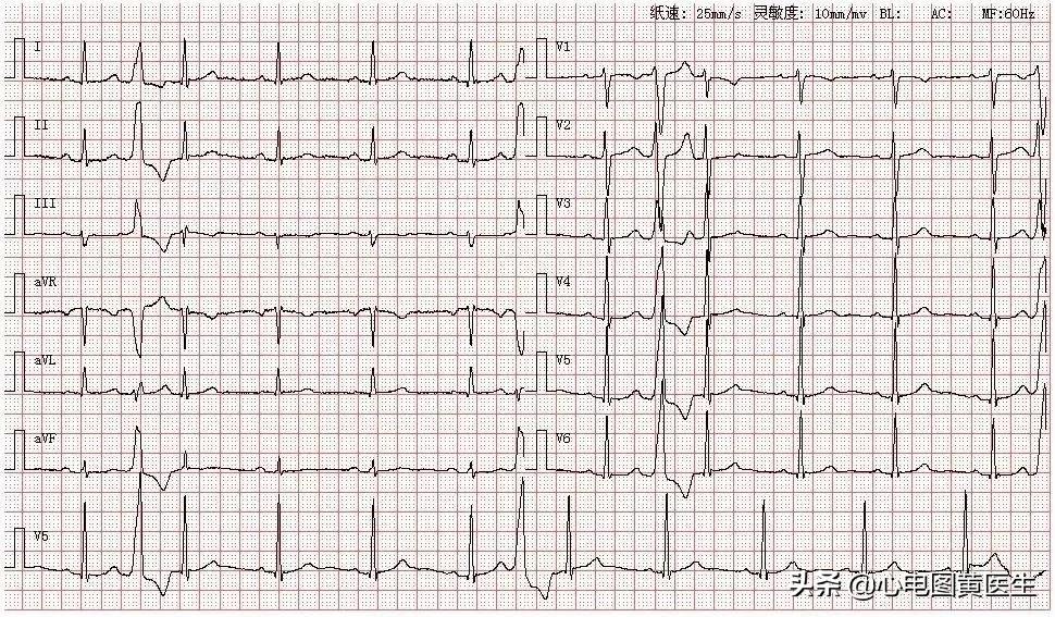 左前分支传导阻滞前胸痛怎么办,左前分支传导阻滞趋势