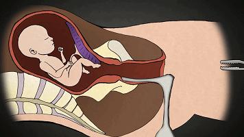 堕胎可怕吗,堕胎到底多可怕