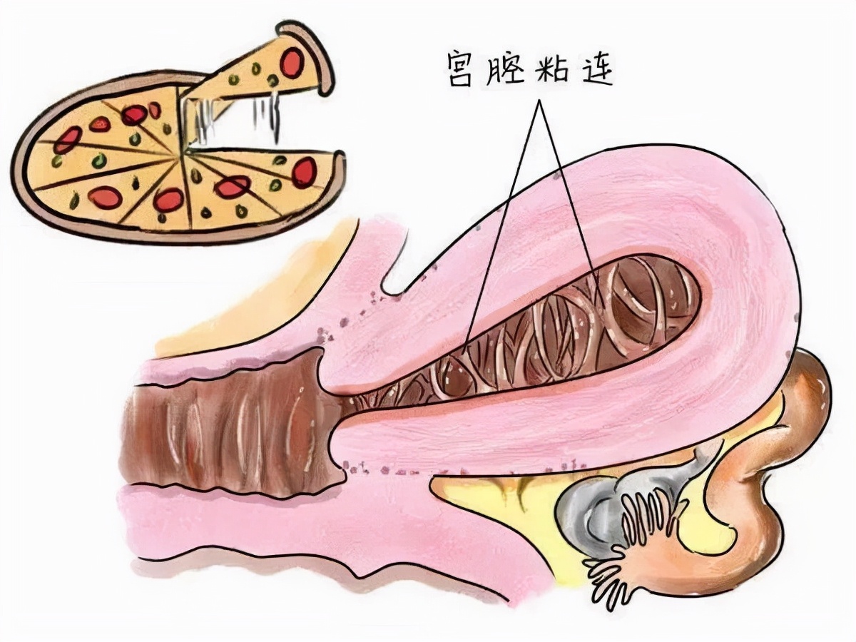 四维超声能看出宫腔粘连吗,做超声能看出来宫腔粘连吗