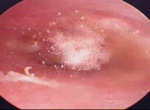 惊!女子耳朵奇痒,竟是因为里面“发霉”长毛了