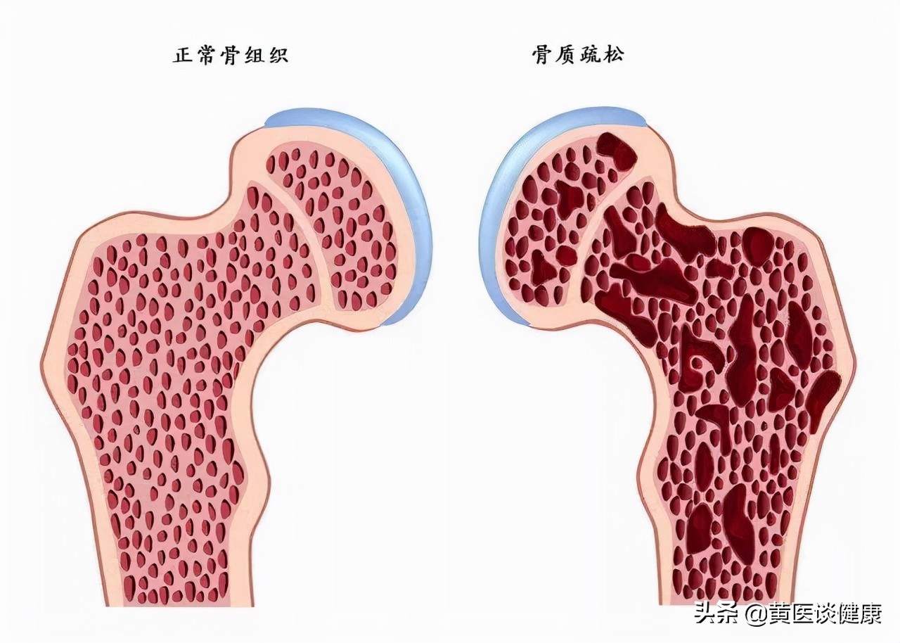预防骨质疏松牢记医生4点,预防骨质疏松能喝液体钙吗