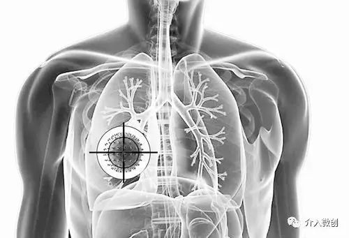 肺转移瘤消融能达到根治效果吗,肺转移瘤中医治疗