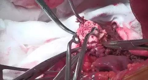 吴孟超院士团队针对肝癌合并门静脉癌栓的特色治疗