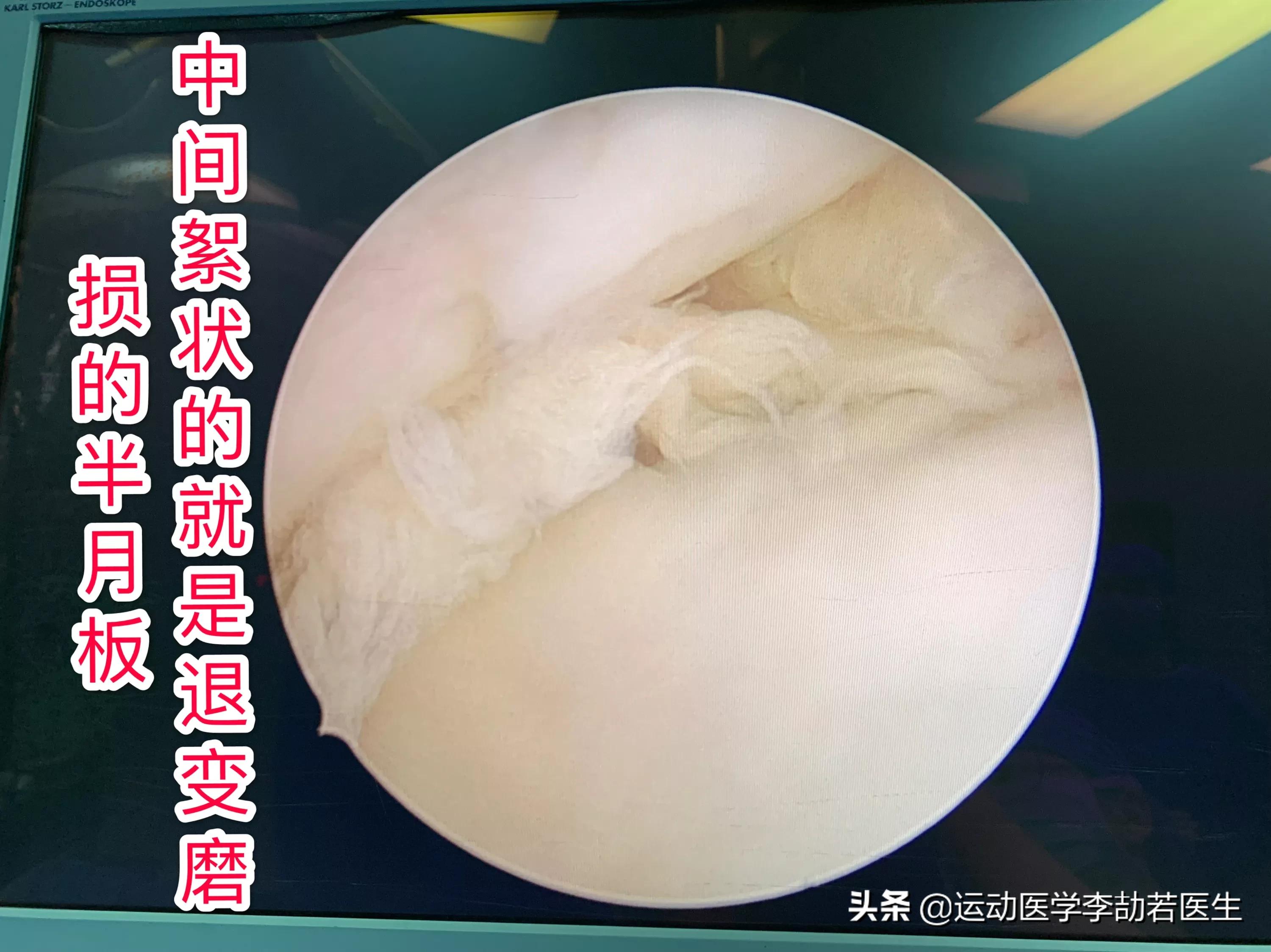 骨关节炎如何彻底治好,骨关节炎怎么治疗最好最有效