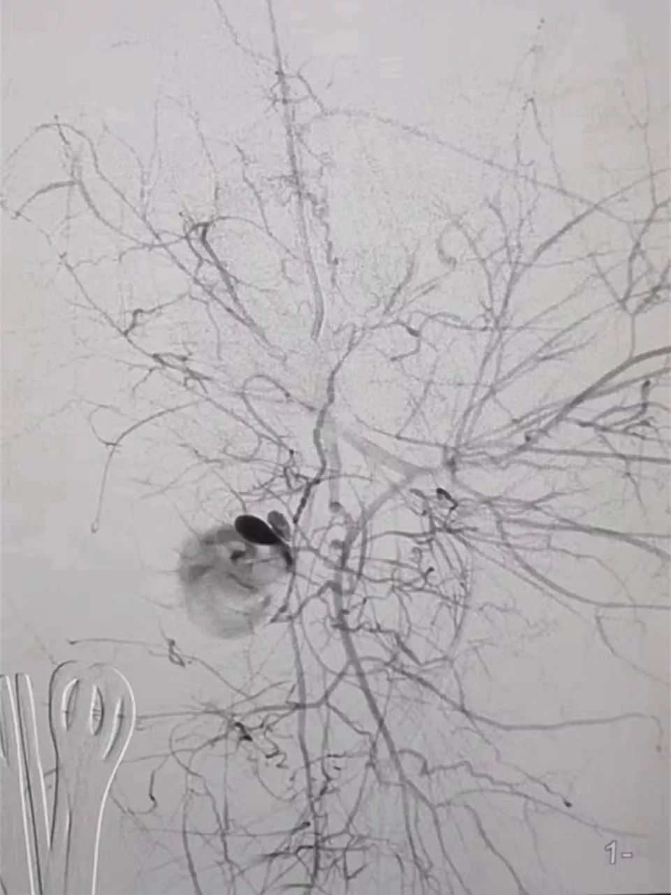 孕妇大出血抢救成功几率,孕妈大出血