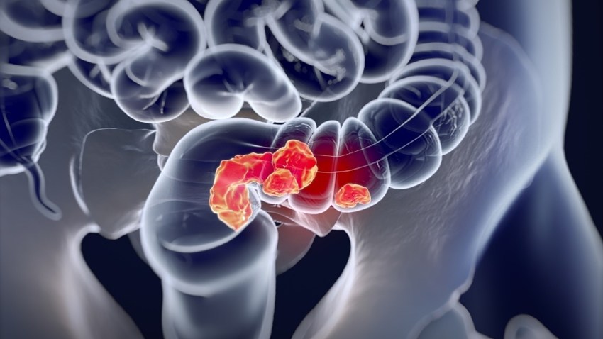 结直肠癌转移有半月能治好吗,结直肠癌转移肺能活多久