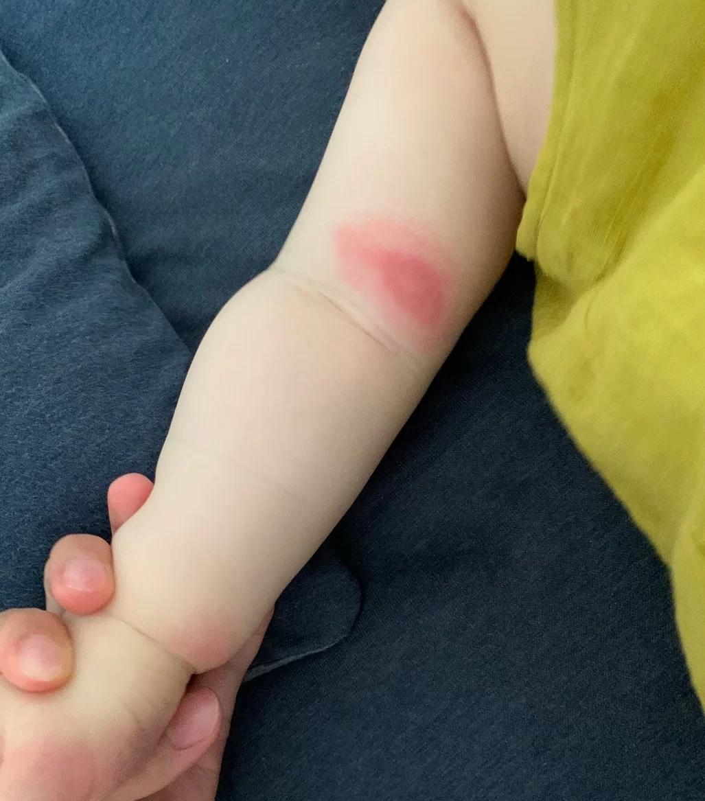 宝宝有蚊子咬搞什么驱蚊,宝宝总被蚊子咬怎么有效驱蚊