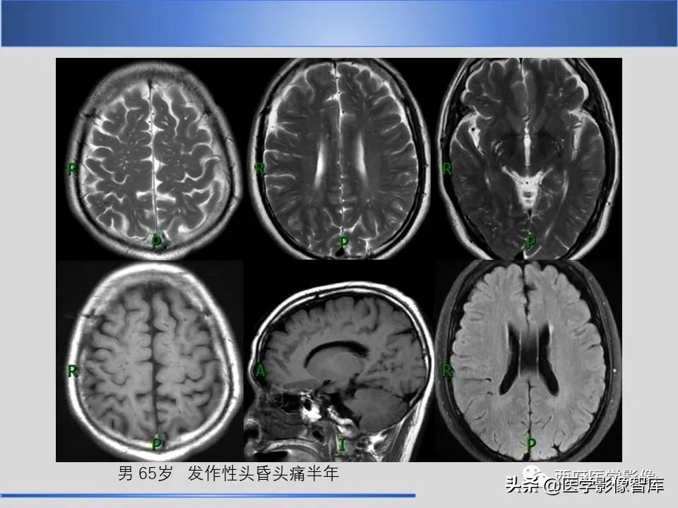 vr间隙概念,vr间隙需要做什么检查