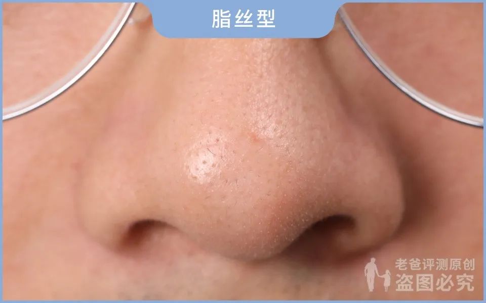 正确科学的去黑头方法一次说清楚,正确的去黑头的方法在这里