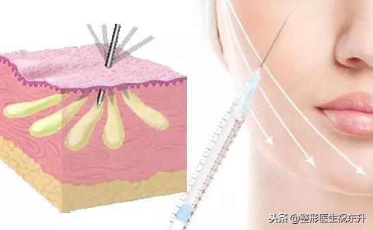 脂肪填充苹果肌多久消肿恢复自然,脂肪填充苹果肌一边多久吸收正常