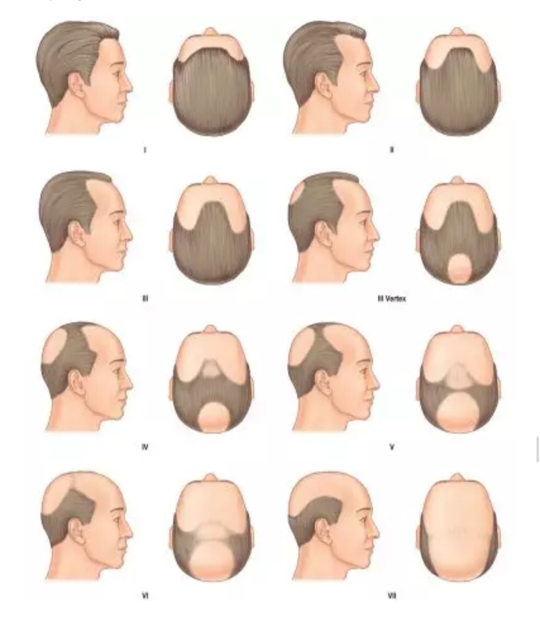 养发护发秃顶,脱发秃顶男