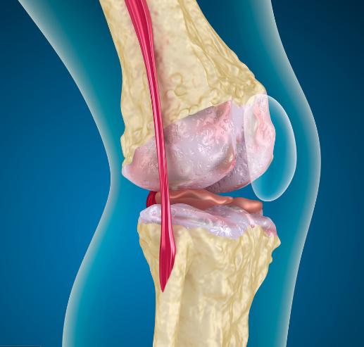 膝关节疼痛滑膜炎的病因及治疗,膝盖滑膜炎积液膝关节疼痛肿胀
