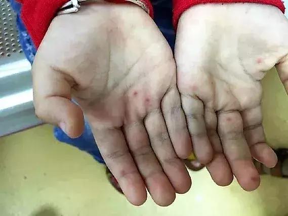 利巴韦林对手足口效果怎么样,手足口病喝利巴韦林