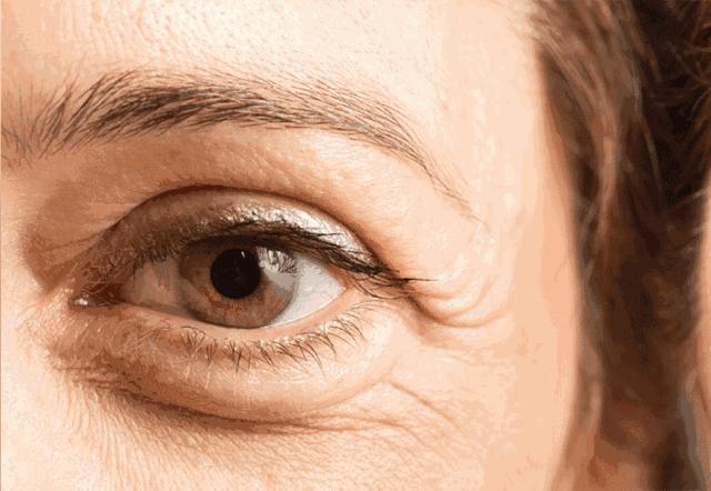 怎么改善熬夜的黑眼圈和眼角细纹,干眼症导致的黑眼圈怎样去除